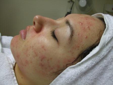 Naomi's acne before treatment